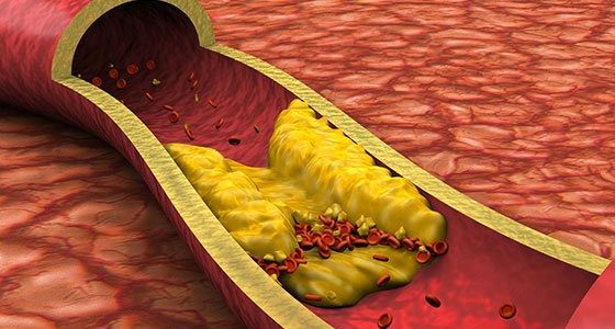 Blood lipids a risk for cardiovascular